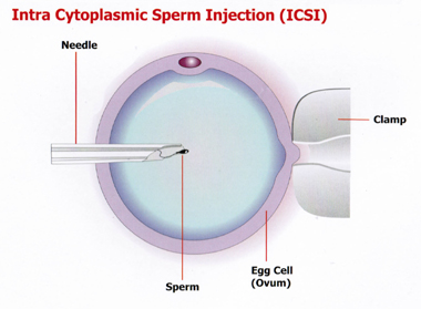 Intra Cytoplasmic Sperm Injection(ICSI)